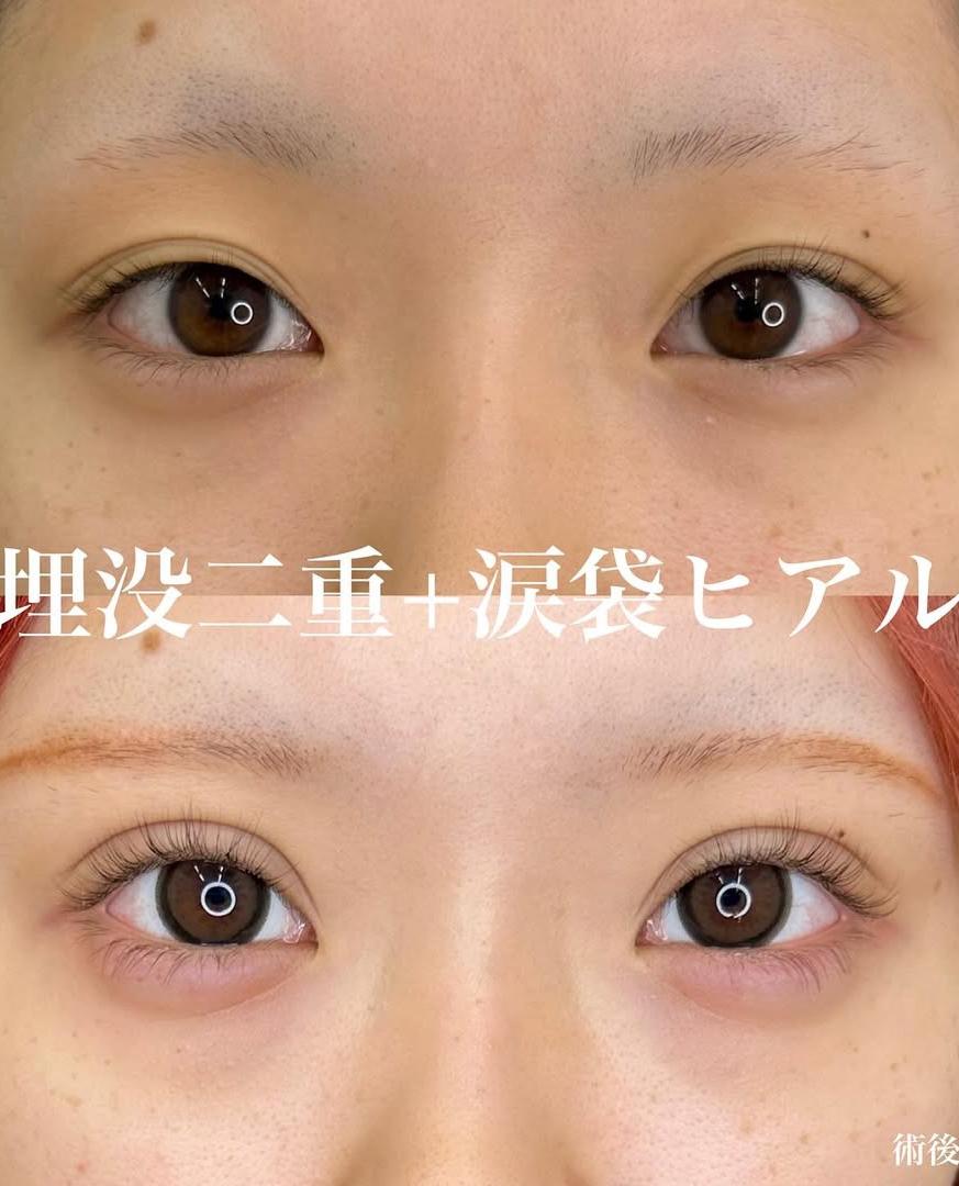 二重埋没