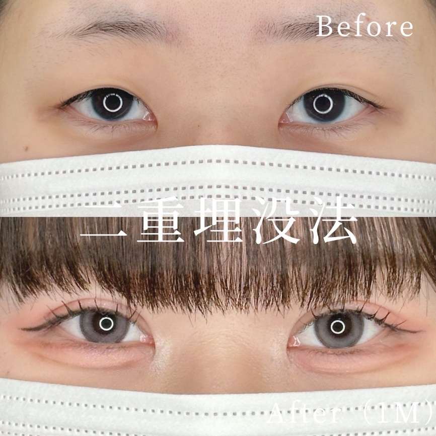 二重埋没
