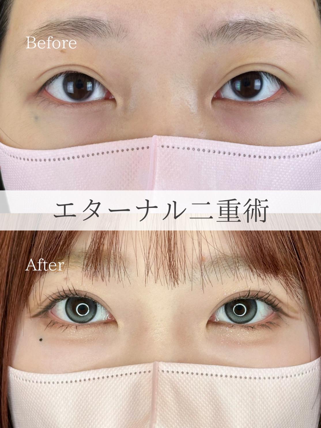 二重埋没