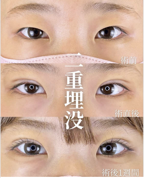 二重埋没