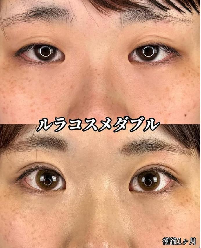 二重埋没
