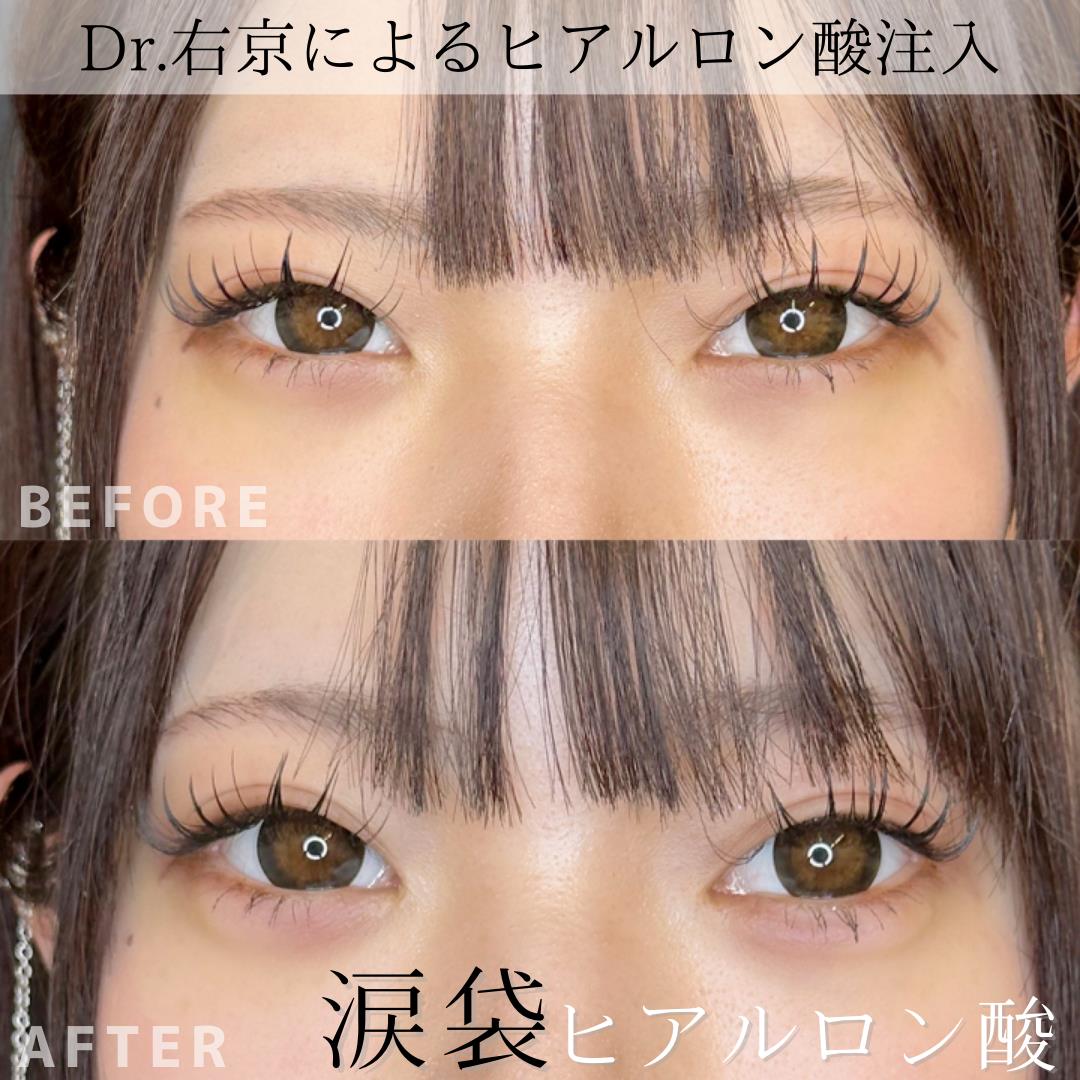 涙袋ヒアルロン酸の症例写真