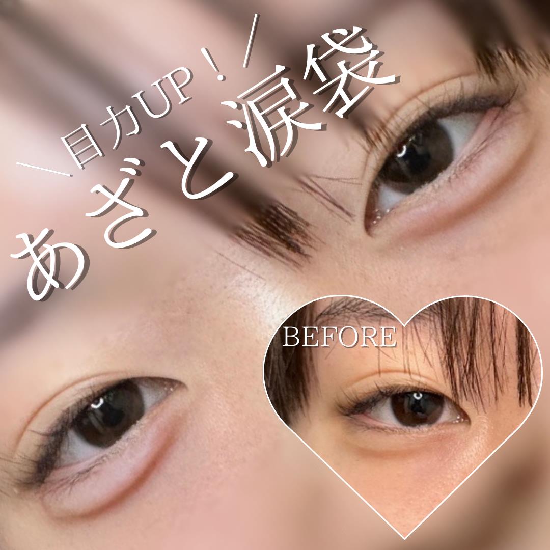 涙袋ヒアルロン酸の症例写真