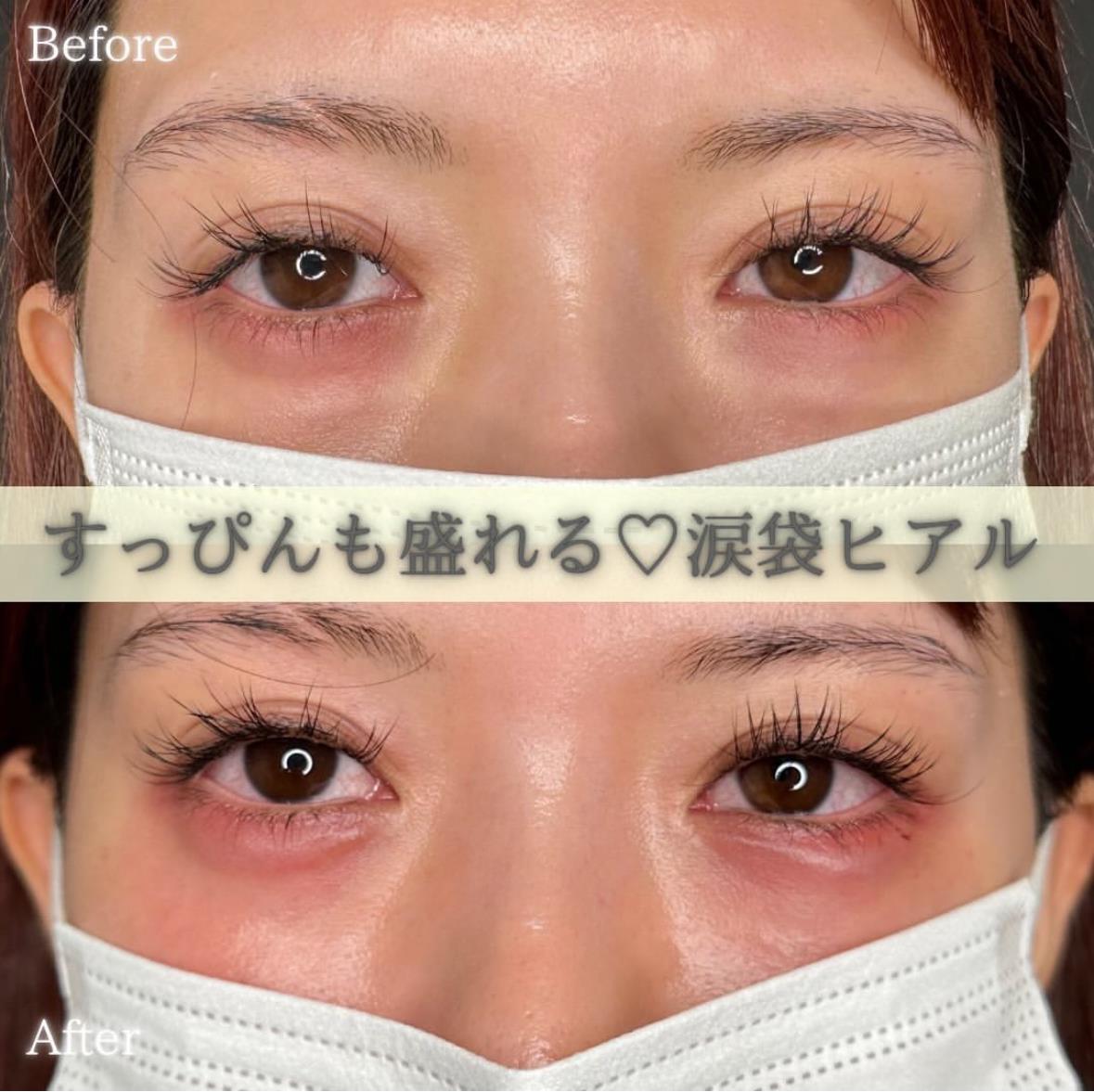 涙袋ヒアルロン酸の症例写真