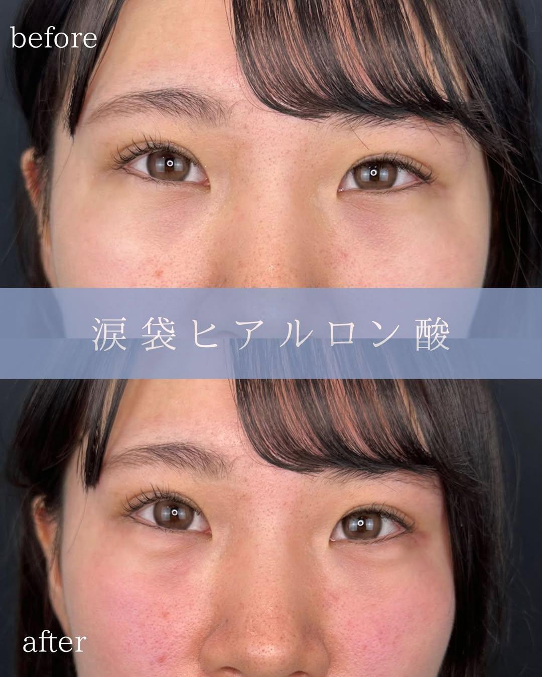涙袋ヒアルロン酸の症例写真