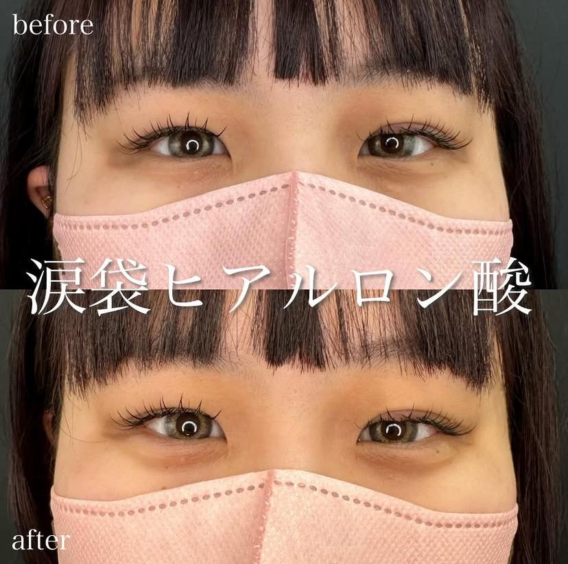 涙袋ヒアルロン酸の症例写真