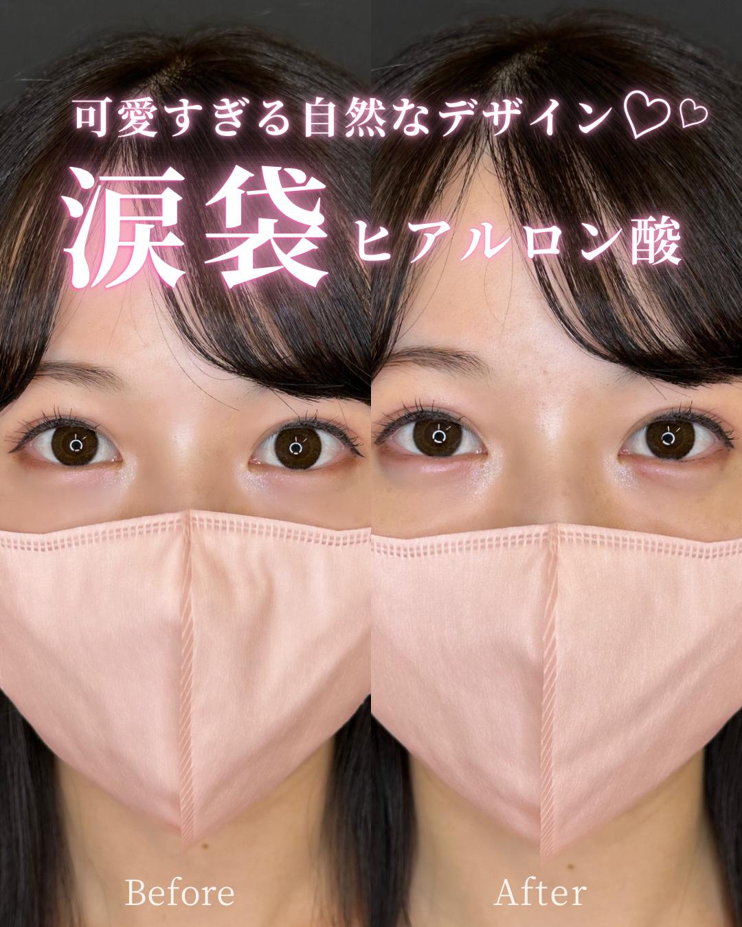 涙袋ヒアルロン酸の症例写真