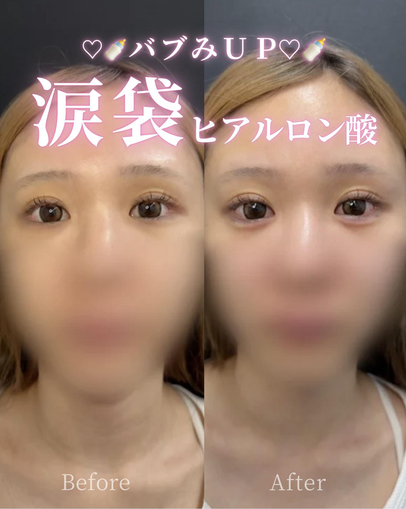 涙袋ヒアルロン酸の症例写真