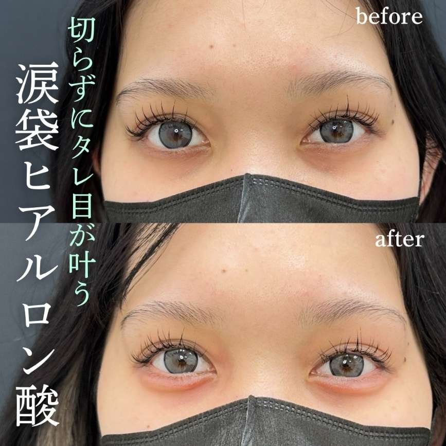 涙袋ヒアルロン酸の症例写真