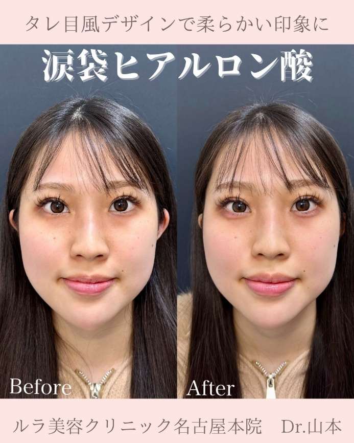 涙袋ヒアルロン酸の症例写真