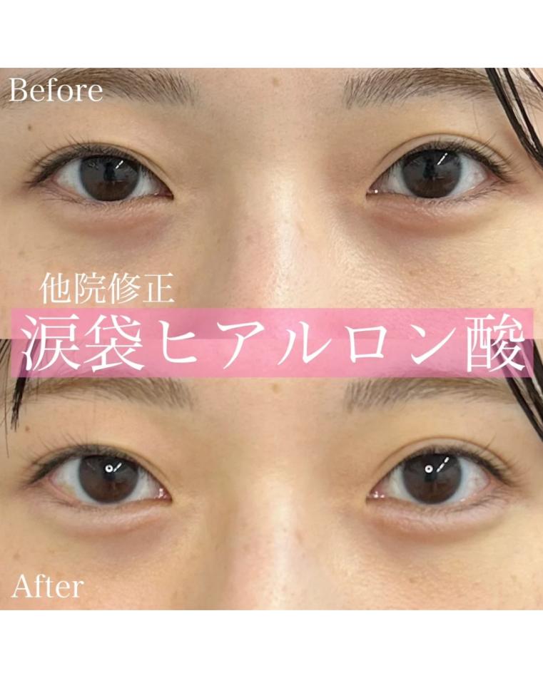 涙袋ヒアルロン酸の症例写真
