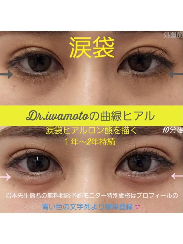 涙袋ヒアルロン酸の症例写真