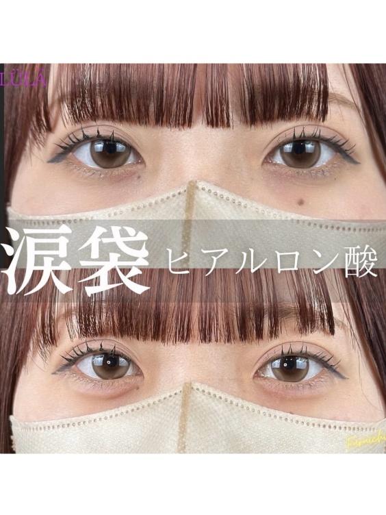 涙袋ヒアルロン酸の症例写真