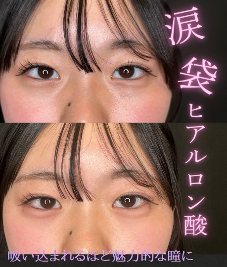 涙袋ヒアルロン酸の症例写真
