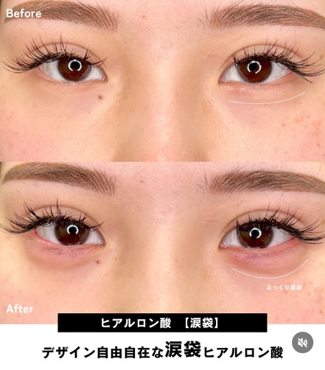 涙袋ヒアルロン酸の症例写真