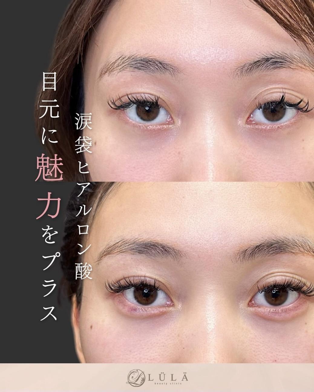涙袋ヒアルロン酸の症例写真