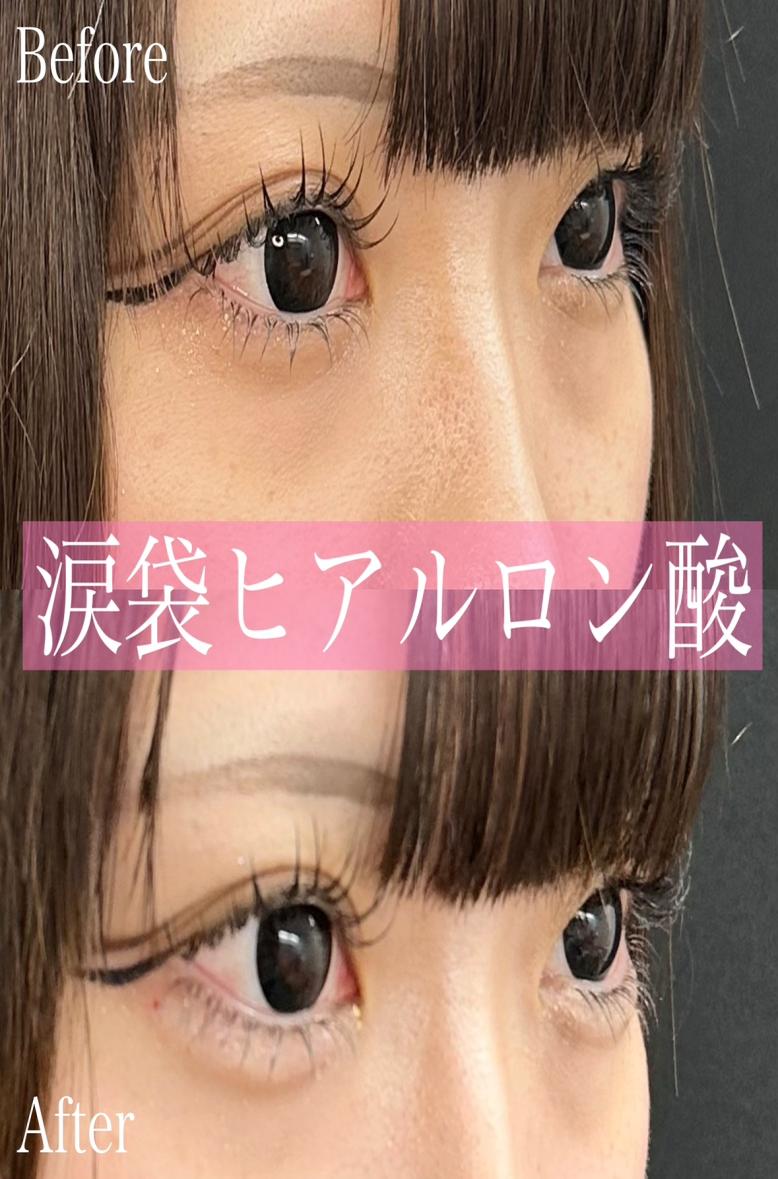 涙袋ヒアルロン酸の症例写真