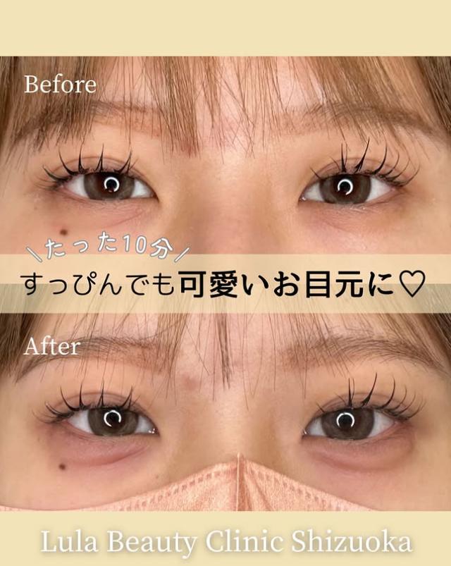 涙袋ヒアルロン酸の症例写真