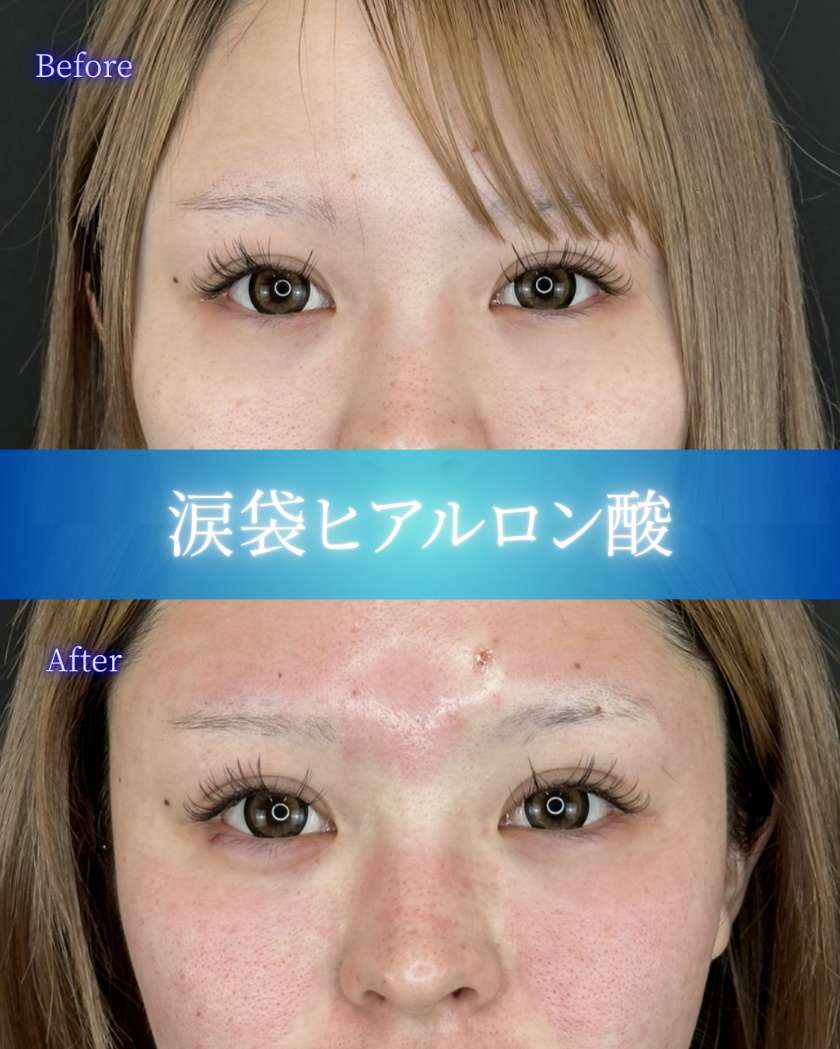 涙袋ヒアルロン酸の症例写真