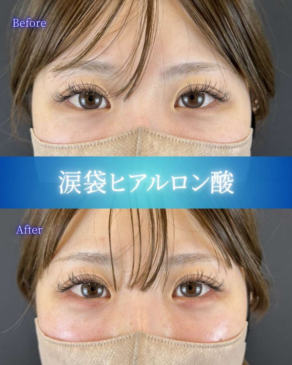 涙袋ヒアルロン酸の症例写真