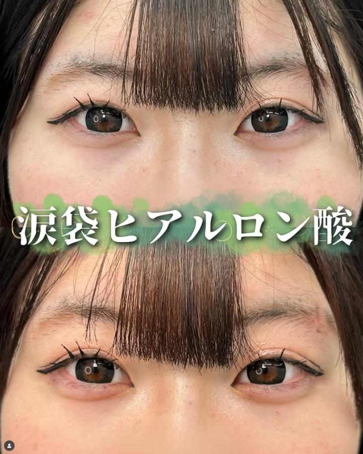 涙袋ヒアルロン酸の症例写真