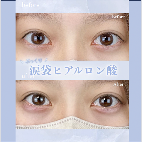 涙袋ヒアルロン酸の症例写真