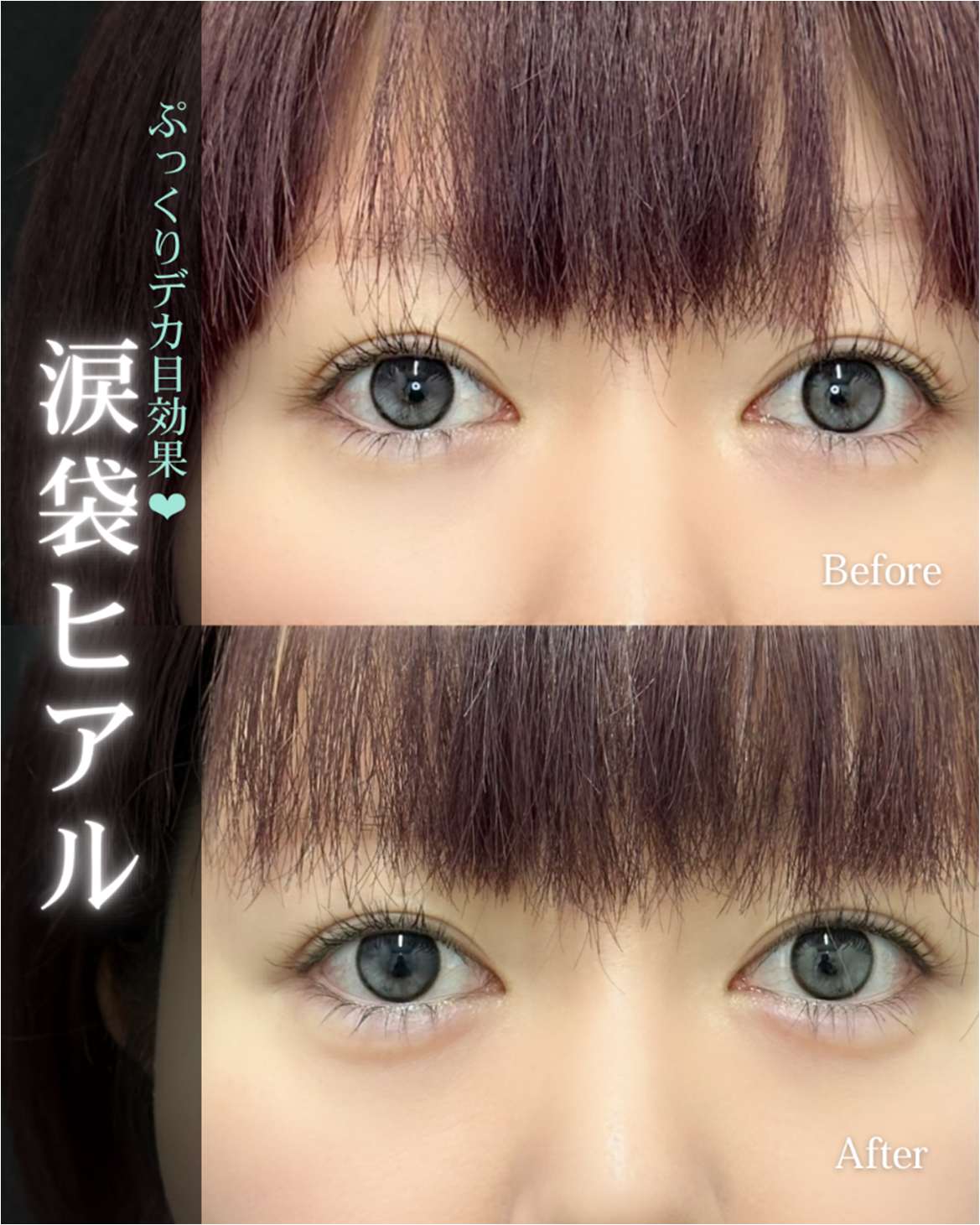 涙袋ヒアルロン酸の症例写真