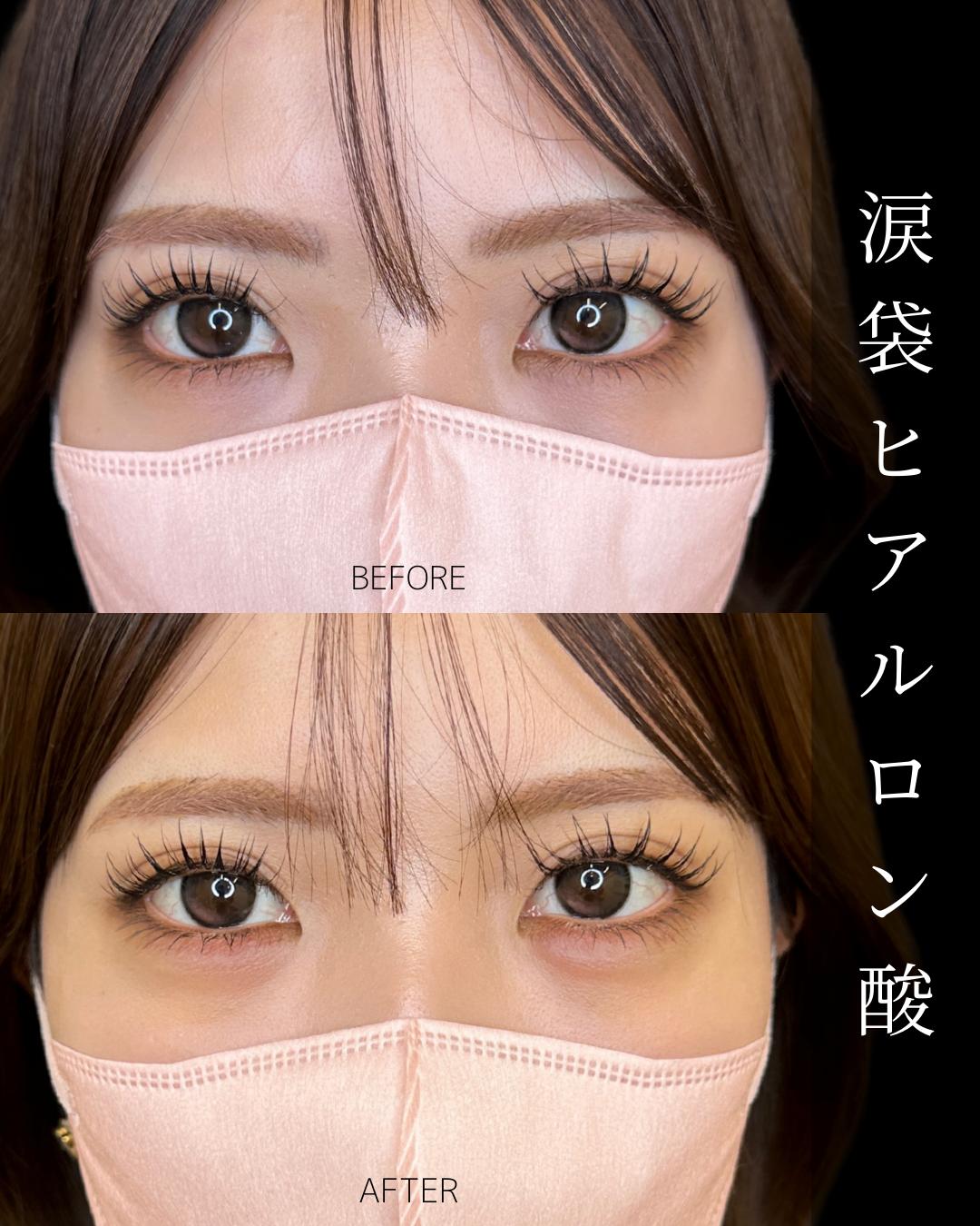 涙袋ヒアルロン酸の症例写真