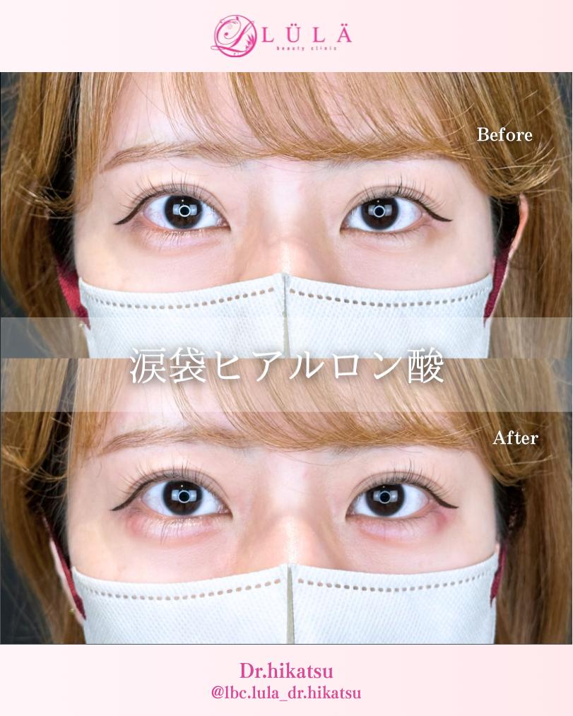 涙袋ヒアルロン酸の症例写真