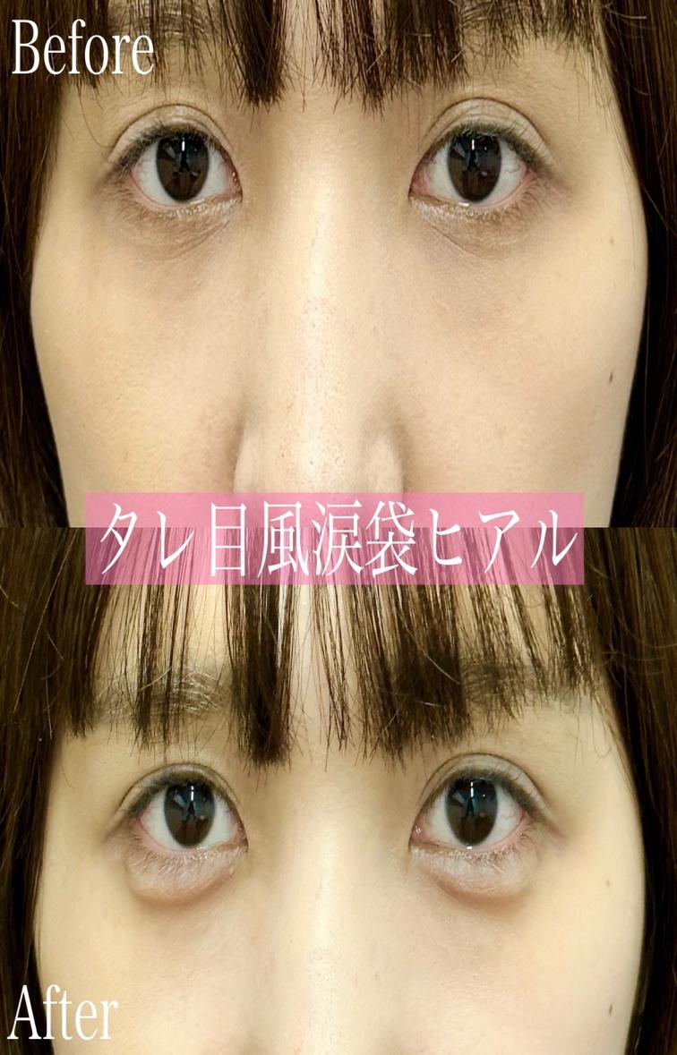 涙袋ヒアルロン酸の症例写真