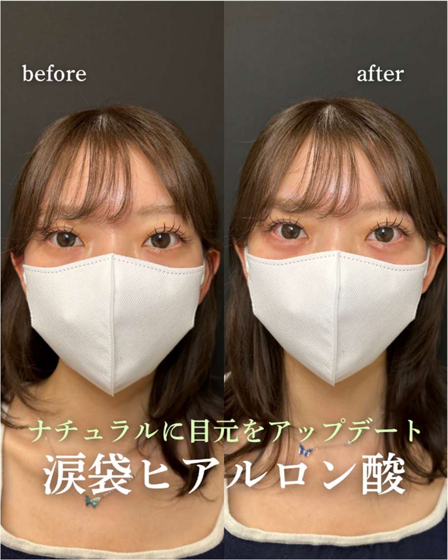 涙袋ヒアルロン酸の症例写真