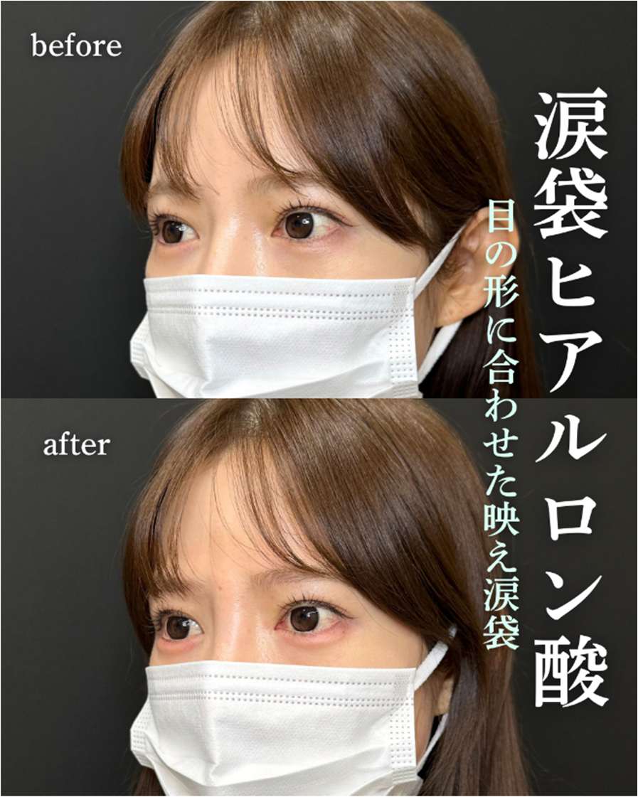 涙袋ヒアルロン酸の症例写真