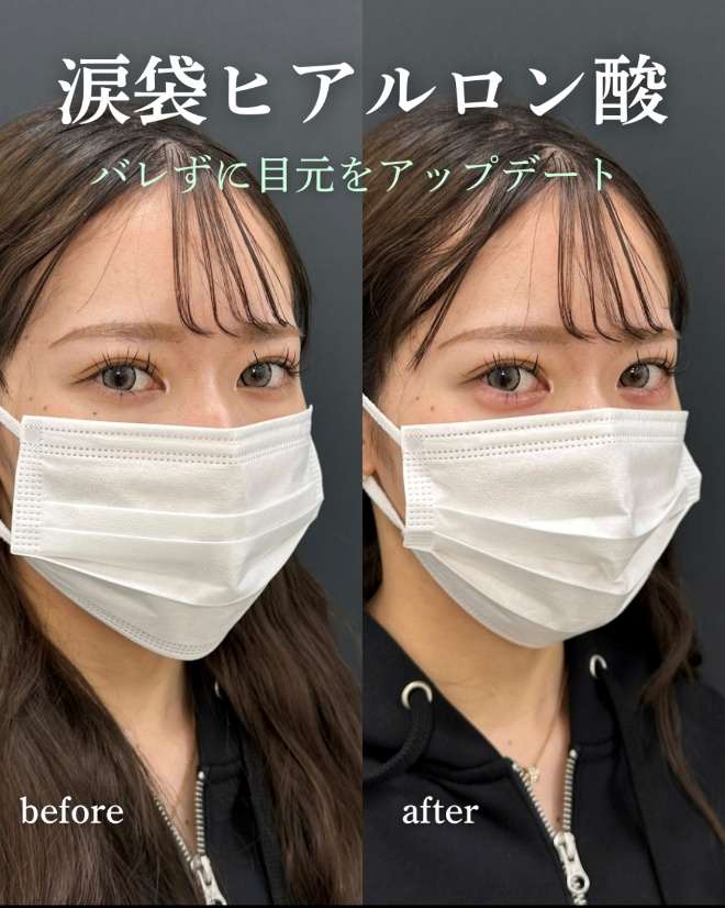 涙袋ヒアルロン酸の症例写真