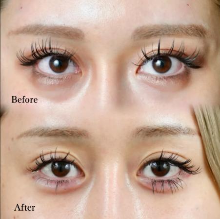 涙袋ヒアルロン酸の症例写真