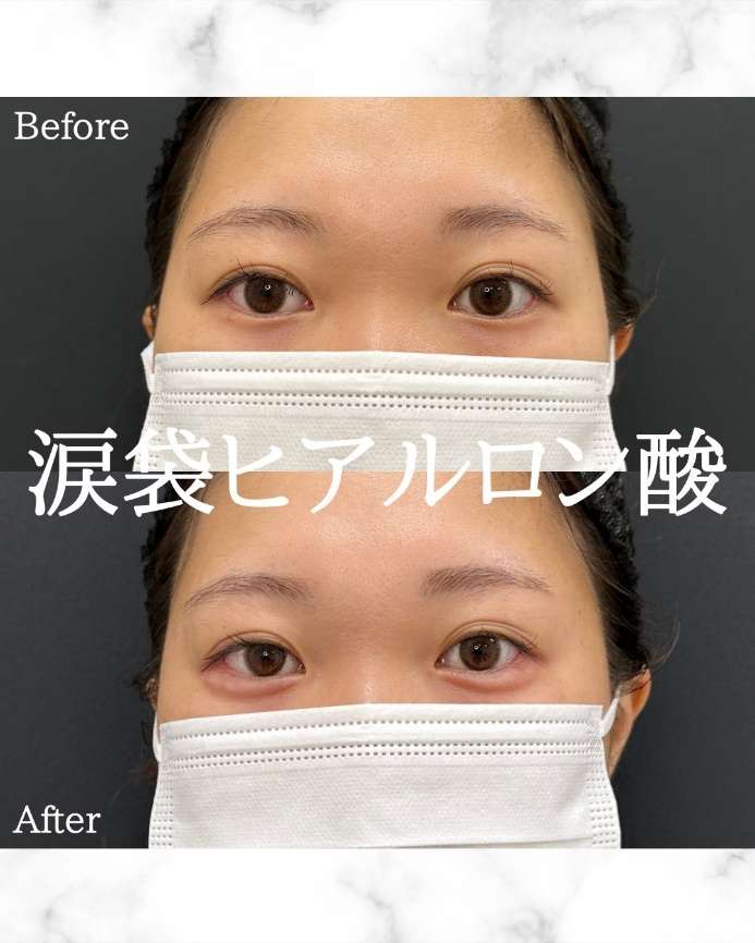 涙袋ヒアルロン酸の症例写真