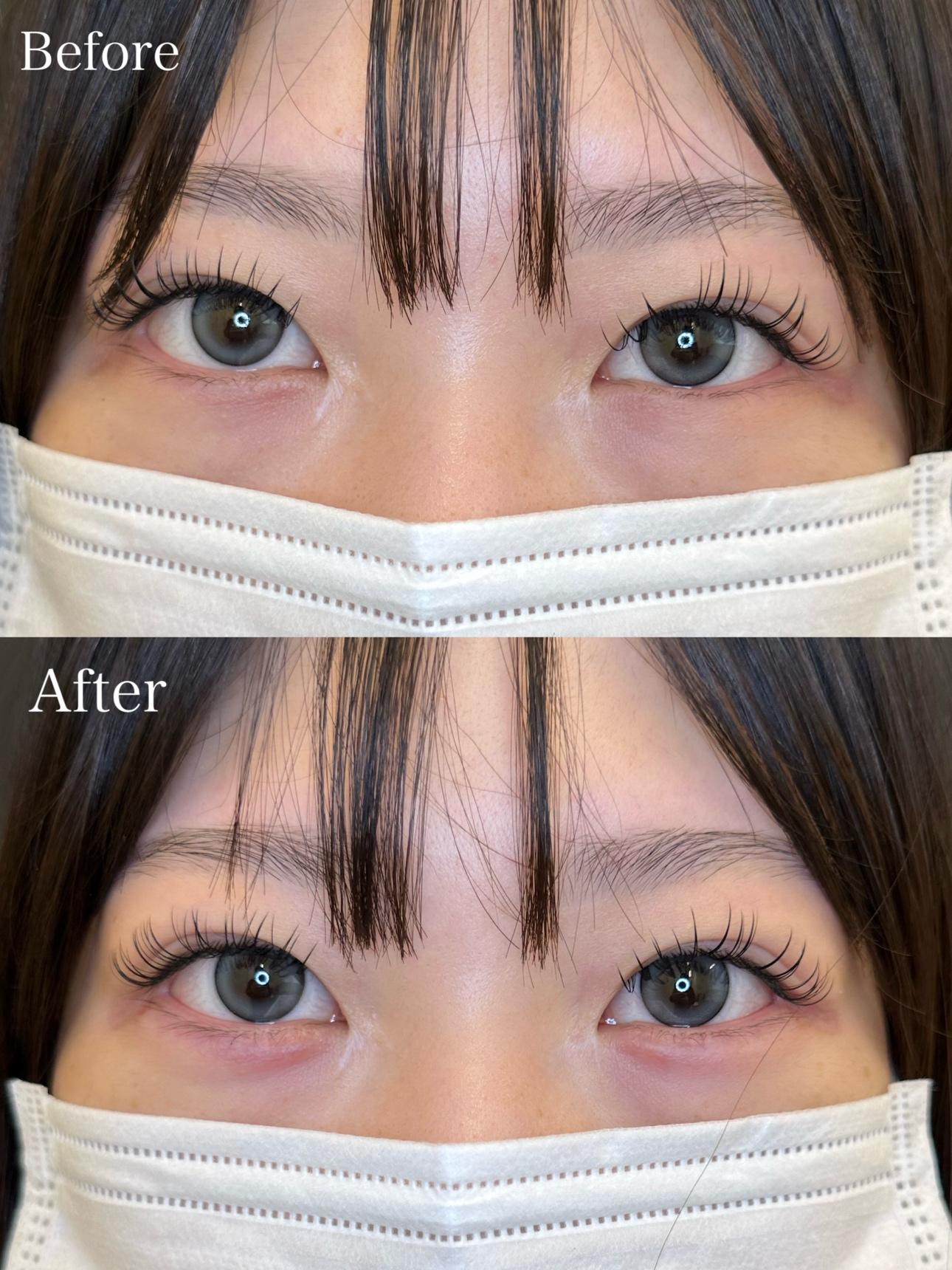 涙袋ヒアルロン酸の症例写真