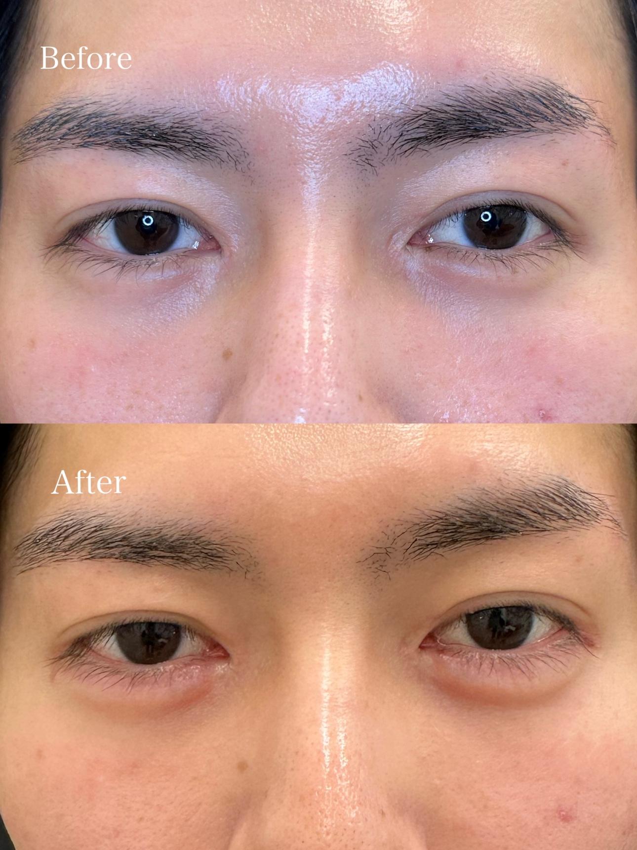 涙袋ヒアルロン酸の症例写真