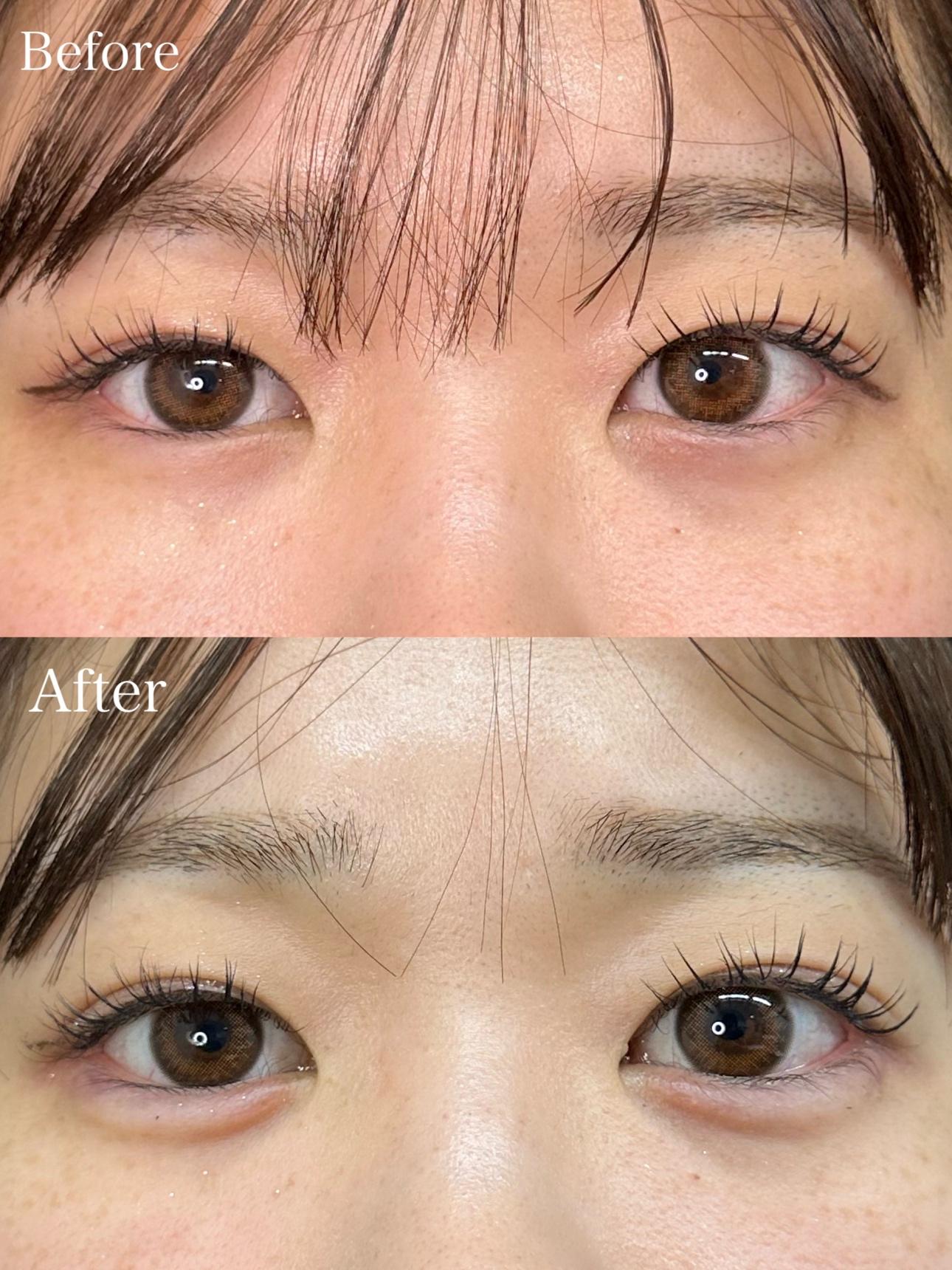 涙袋ヒアルロン酸の症例写真