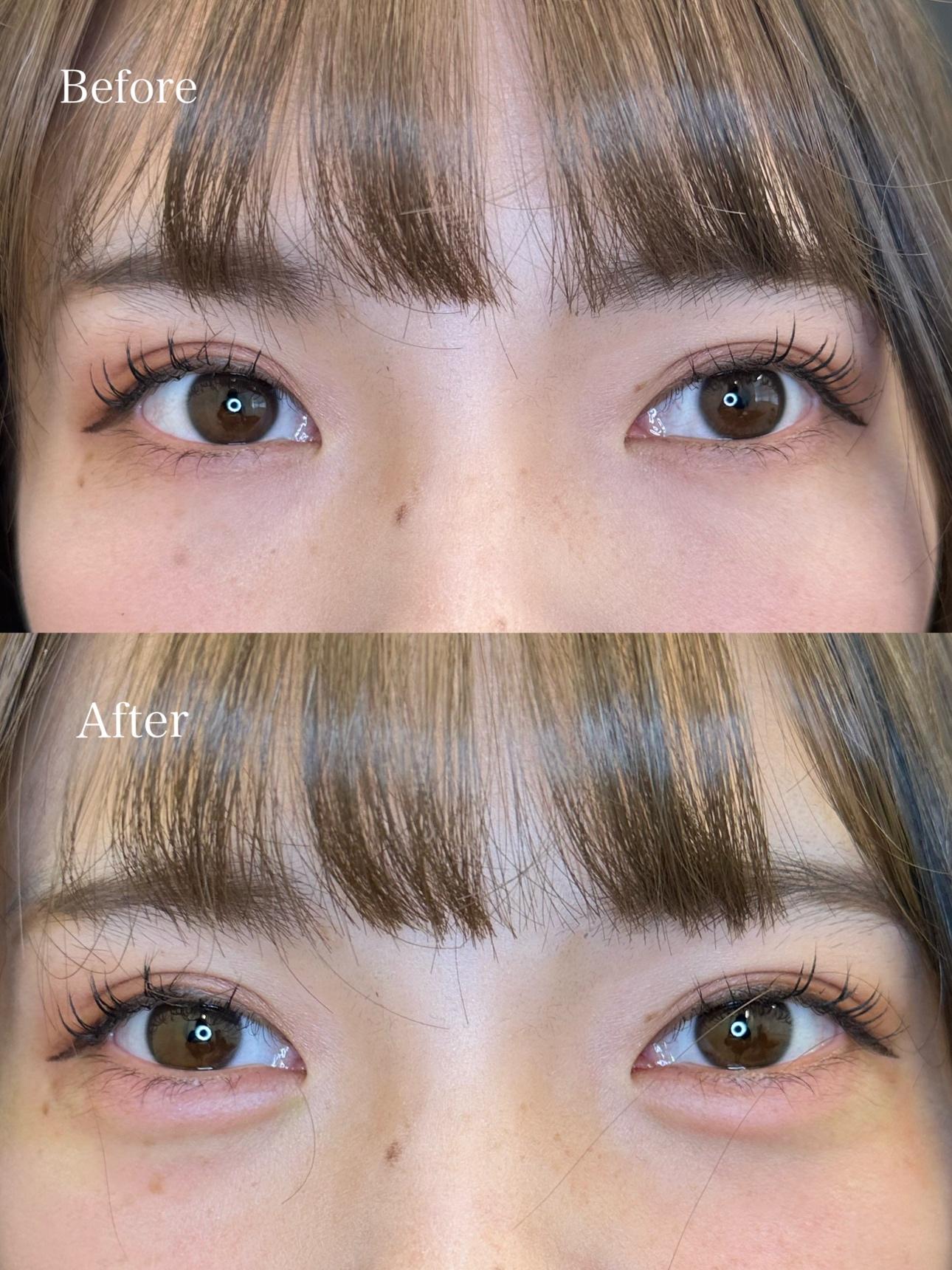 涙袋ヒアルロン酸の症例写真