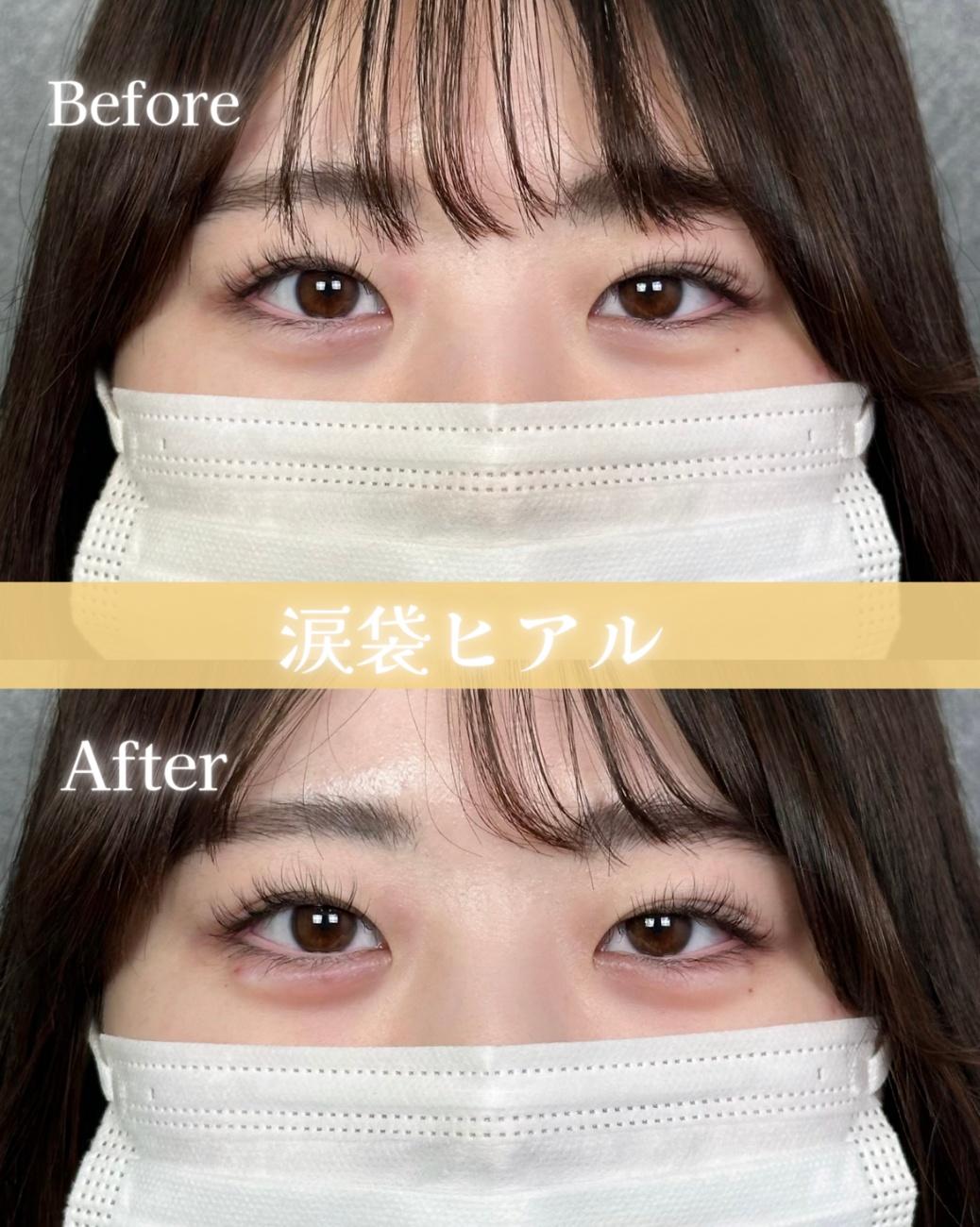 涙袋ヒアルロン酸の症例写真