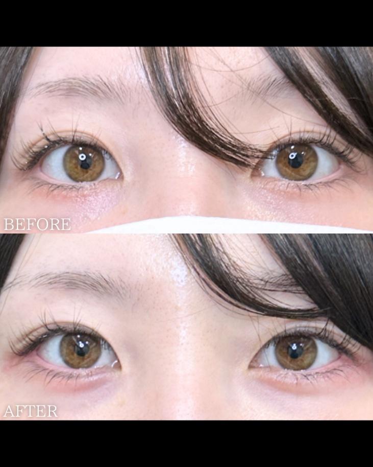 涙袋ヒアルロン酸の症例写真