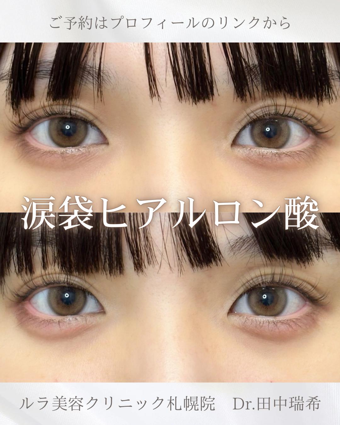 涙袋ヒアルロン酸の症例写真