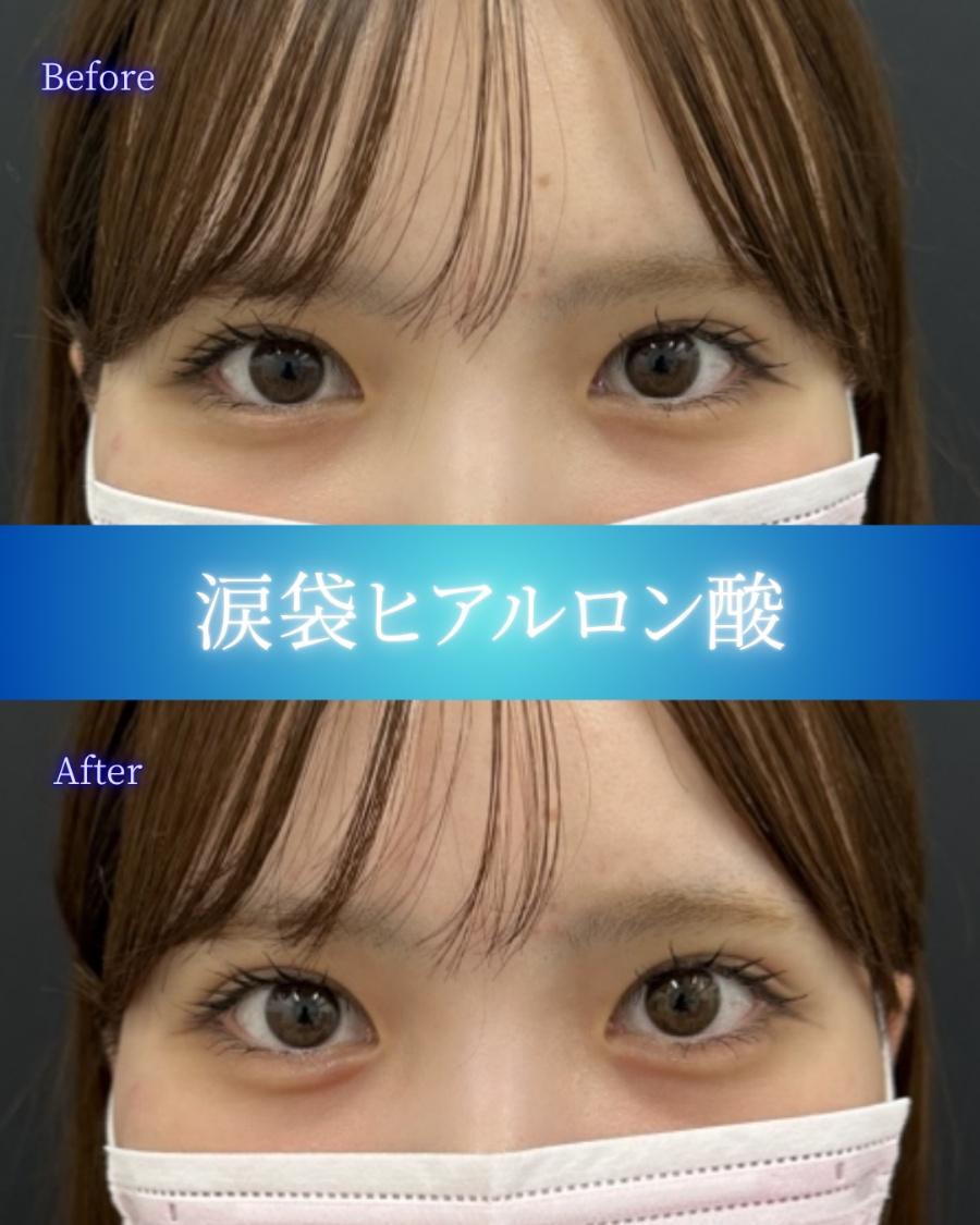 涙袋ヒアルロン酸の症例写真