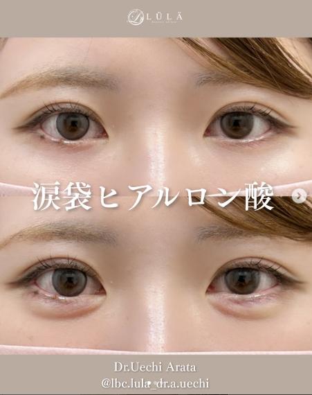 涙袋ヒアルロン酸の症例写真