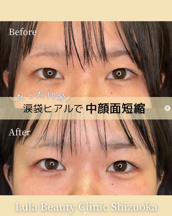 涙袋ヒアルロン酸の症例写真