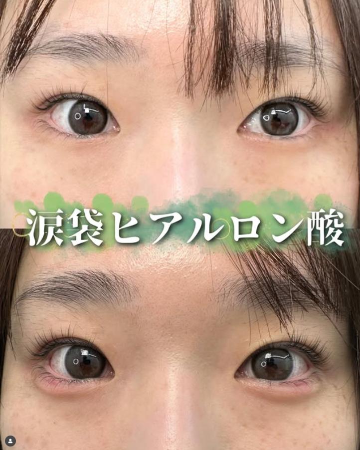 涙袋ヒアルロン酸の症例写真