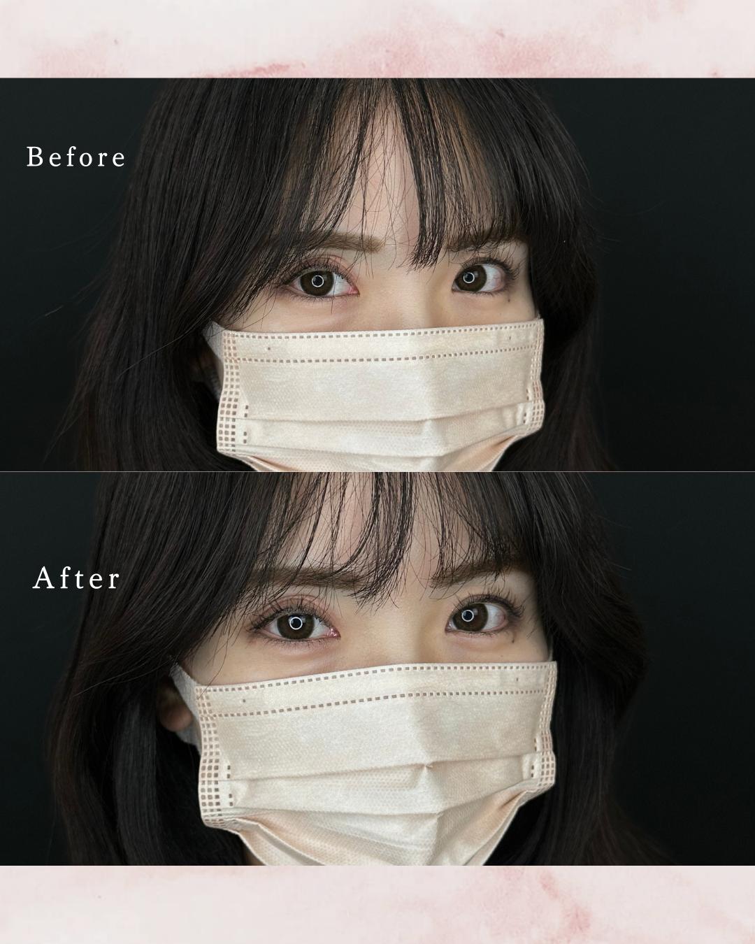 涙袋ヒアルロン酸の症例写真