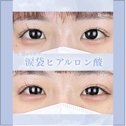 涙袋ヒアルロン酸の症例写真