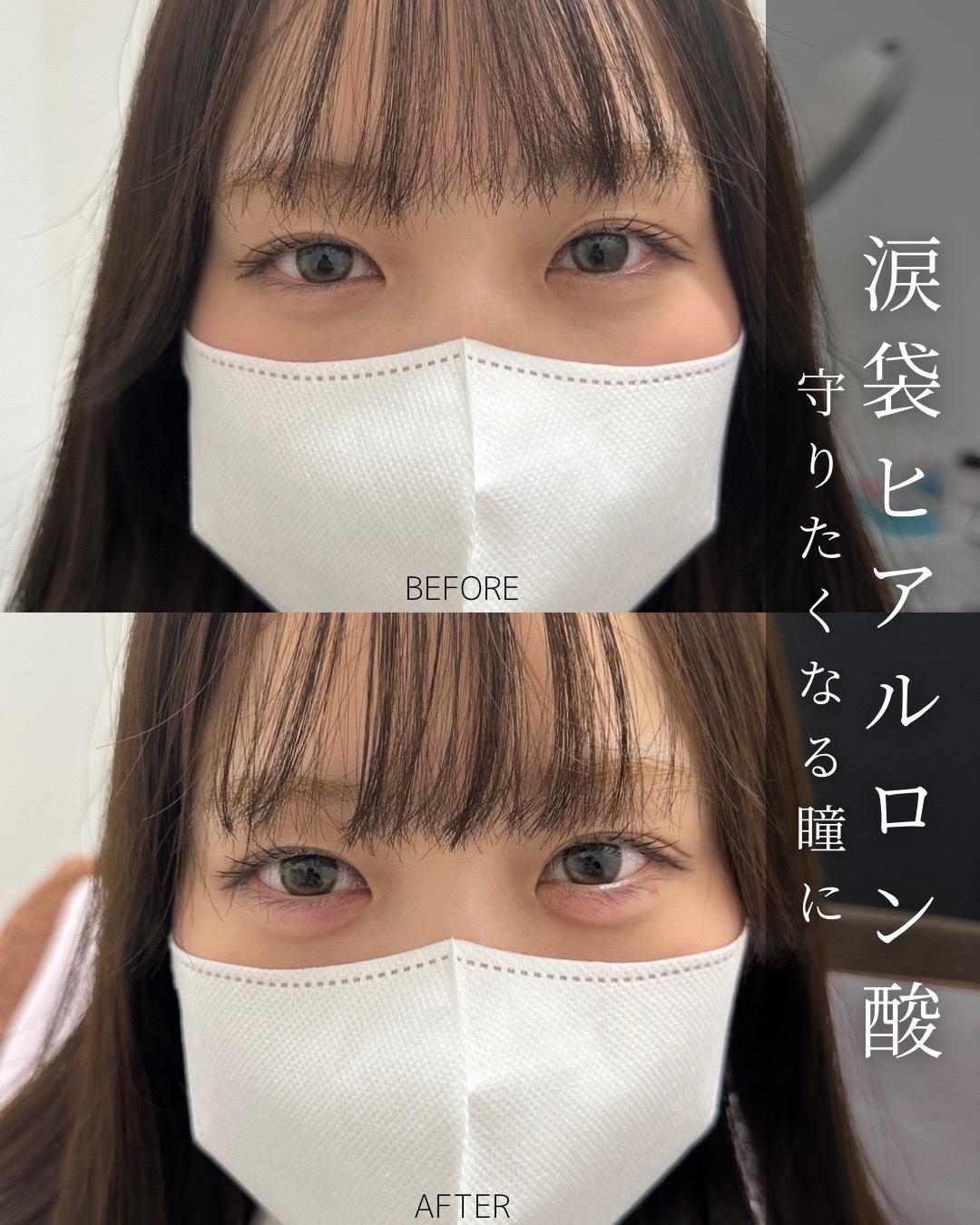 涙袋ヒアルロン酸の症例写真