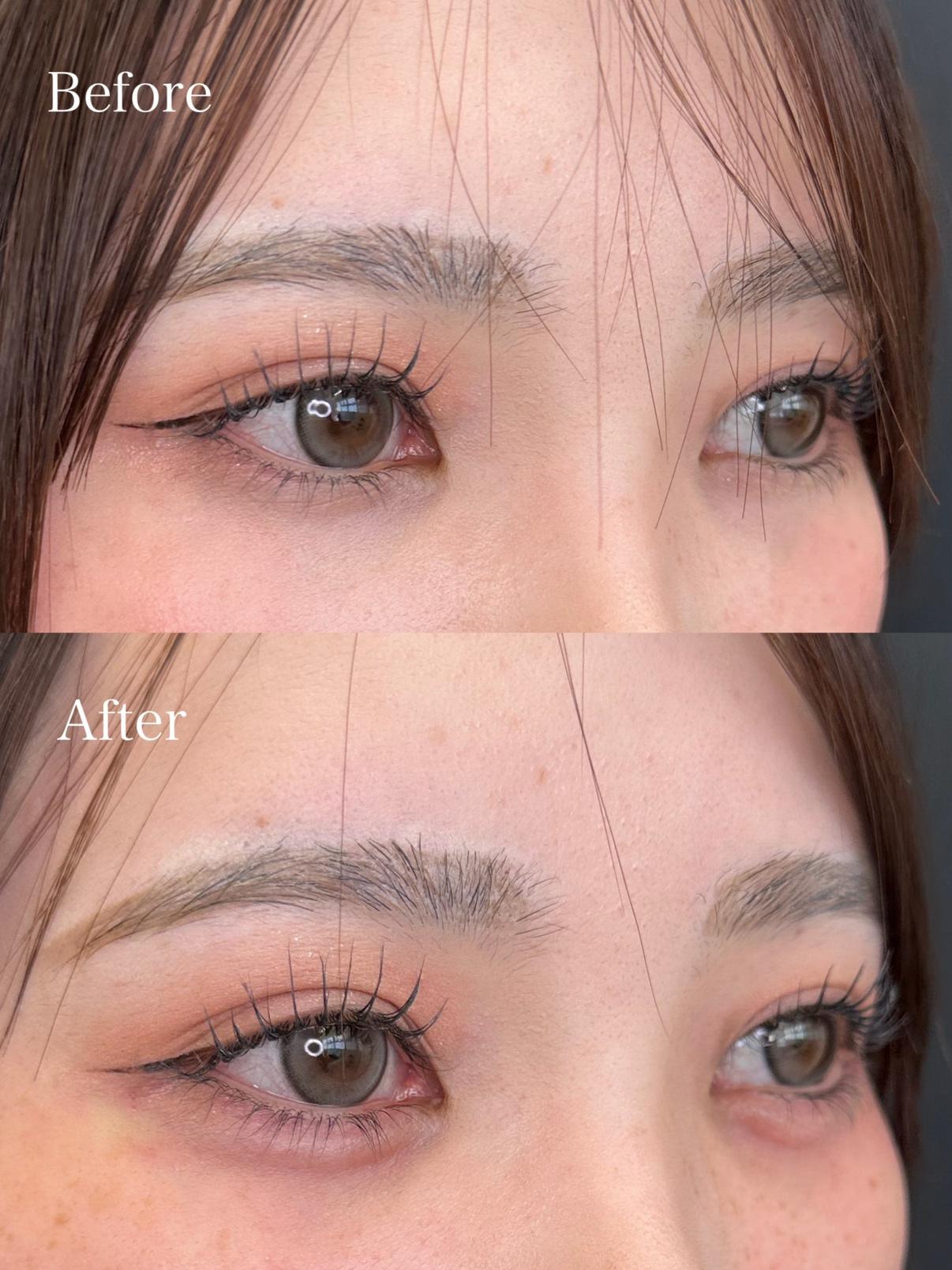 涙袋ヒアルロン酸の症例写真